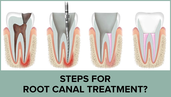 Does Health Insurance Cover Root Canal Treatment Does Health Insurance Cover Root Canal Treatment